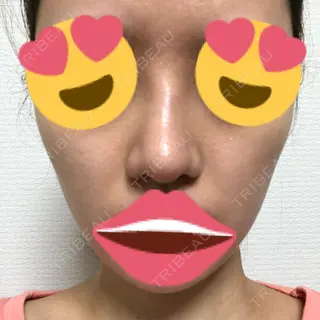 30日目の経過画像（1枚目）
