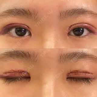 0日目の経過画像（1枚目）
