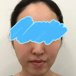 74日目の経過画像（1枚目）