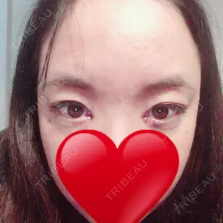 3日目の経過画像（1枚目）