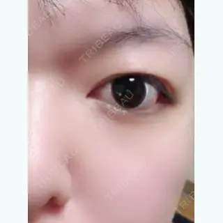 6日目の経過画像（2枚目）