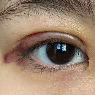 3日目の経過画像（2枚目）