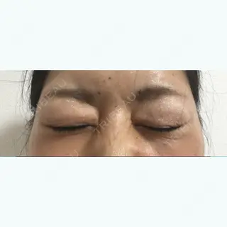 2日目の経過画像（1枚目）