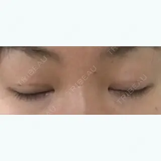 13日目の経過画像（3枚目）