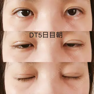 5日目の経過画像（1枚目）