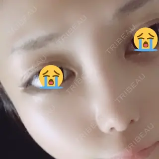 11日目の経過画像（2枚目）