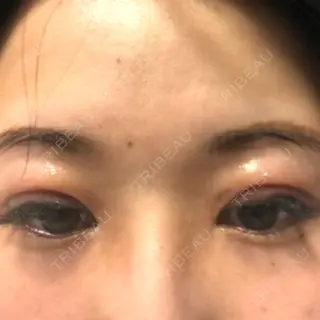 2日目の経過画像（1枚目）