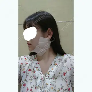 0日目の経過画像（3枚目）