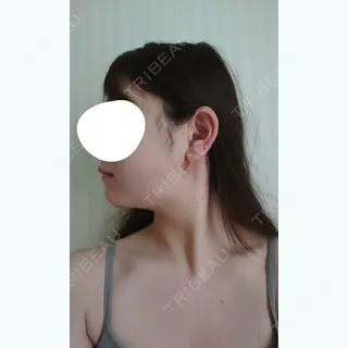 2日目の経過画像（3枚目）