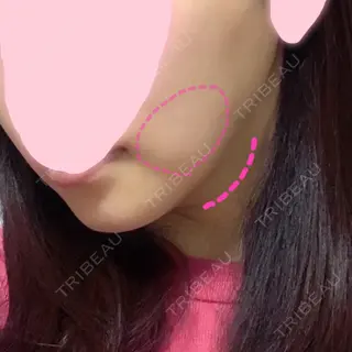 16日目の経過画像（3枚目）