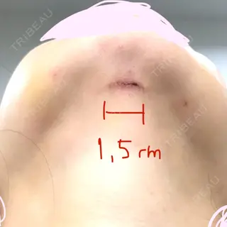 5日目の経過画像（2枚目）