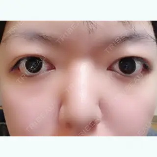 8日目の経過画像（3枚目）