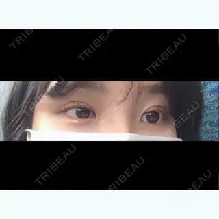 17日目の経過画像（1枚目）