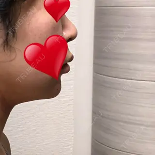 25日目の経過画像（1枚目）