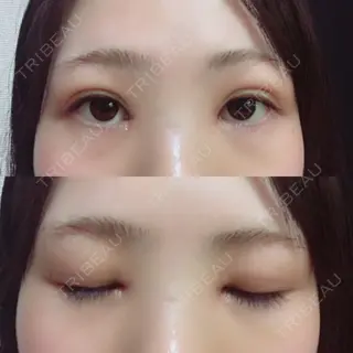 14日目の経過画像（1枚目）