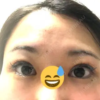 4日目の経過画像（1枚目）