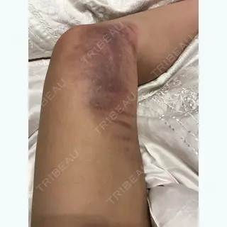 6日目の経過画像（2枚目）