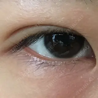 16日目の経過画像（1枚目）