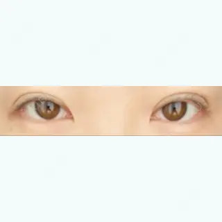 28日目の経過画像（1枚目）
