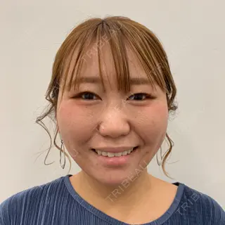 68日目の経過画像（2枚目）
