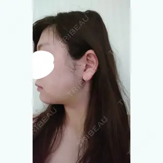 5日目の経過画像（3枚目）