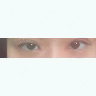 1日目の経過画像（1枚目）