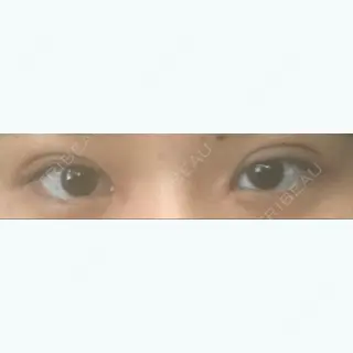 2日目の経過画像（1枚目）