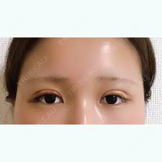 6日目の経過画像（1枚目）