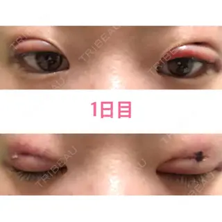 1日目の経過画像（1枚目）