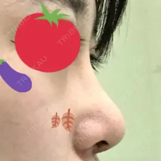 7日目の経過画像（3枚目）
