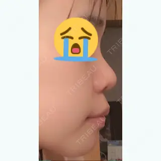 68日目の経過画像（1枚目）