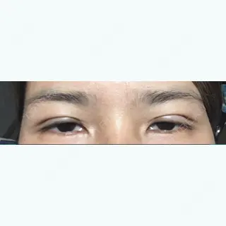 0日目の経過画像（1枚目）