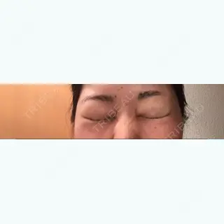 5日目の経過画像（1枚目）