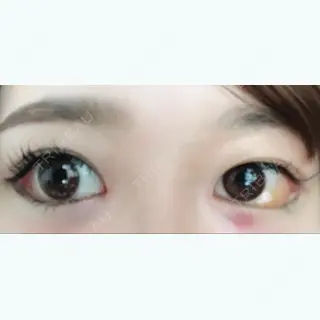 12日目の経過画像（1枚目）