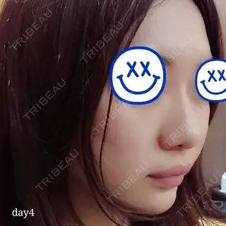 4日目の経過画像（2枚目）
