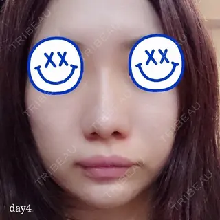 4日目の経過画像（3枚目）