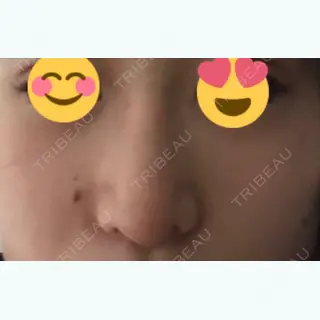 9日目の経過画像（1枚目）