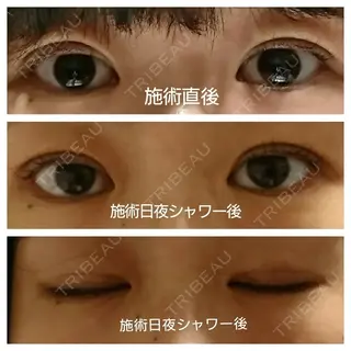 0日目の経過画像（1枚目）