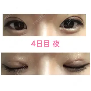 4日目の経過画像（1枚目）
