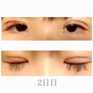 2日目の経過画像（1枚目）