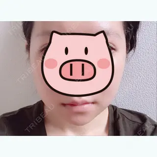44日目の経過画像（1枚目）