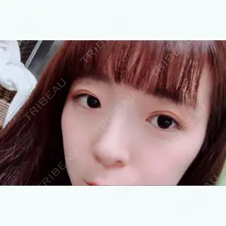8日目の経過画像（1枚目）