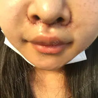 2日目の経過画像（1枚目）