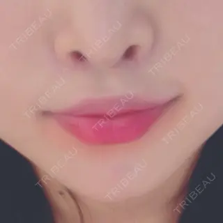 8日目の経過画像（2枚目）