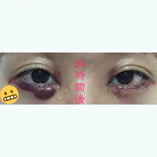 1日目の経過画像（1枚目）