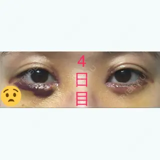 4日目の経過画像（1枚目）
