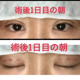 1日目の経過画像（1枚目）