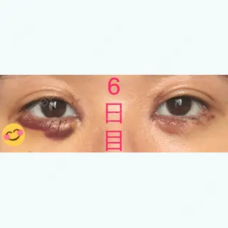 6日目の経過画像（1枚目）