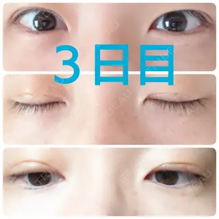 3日目の経過画像（1枚目）