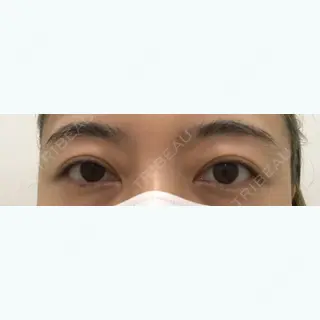 185日目の経過画像（1枚目）